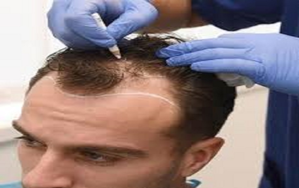 1747042183-Hair_Transplant_Cost_in_Dubai13.jpg