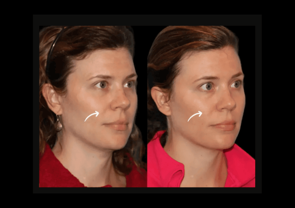 1747310448-Sculptra_(3).png