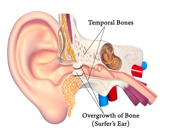 1747668805-ear-diagram-surfers-ear.jpg