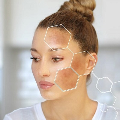 1747726607-Melasma_Treatment_in_Islamabad.jpg