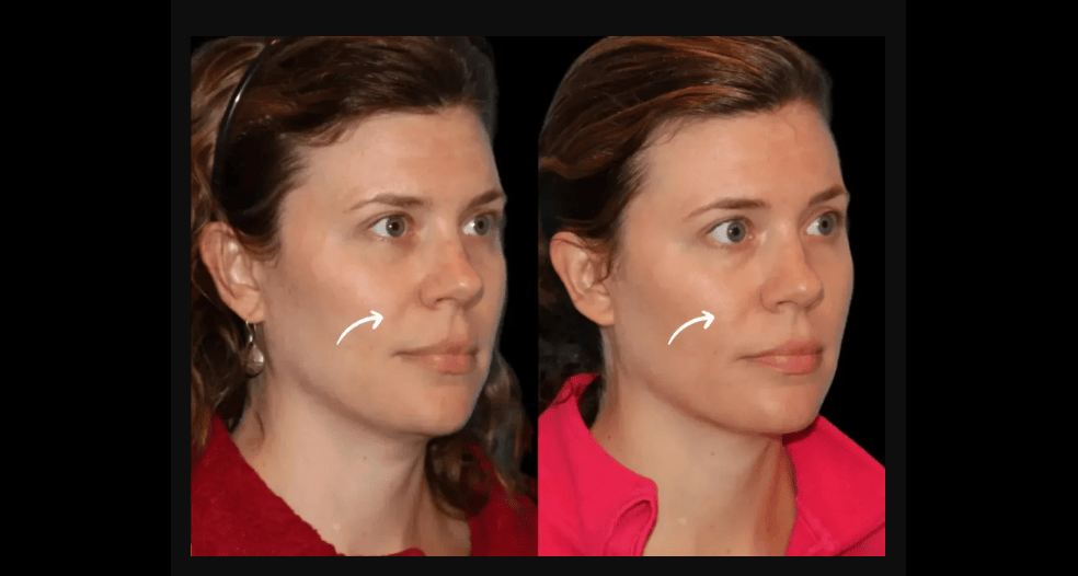 1748247738-Sculptra_(1).png