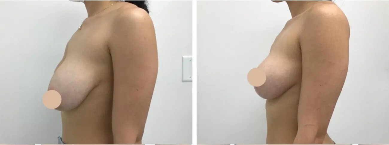 1748283867-H17-Breast-Lift.jpg