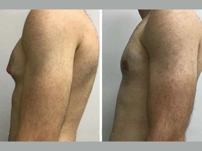 1748288439-H9-Gynecomastia.jpg