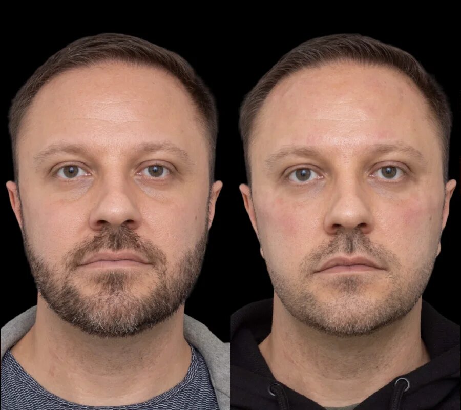 1748338362-H6-Under-eye-fillers.jpg