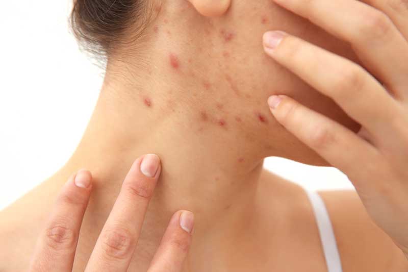 1748342567-How_Affordable_Is_Professional_Acne_Treatment.jpg