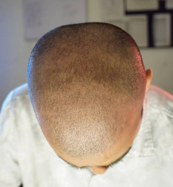 1749540175-Does_Scalp_Micropigmentation_Fade_Over_Time.jpg