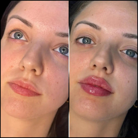 1749595979-H5-lip-fillers_(1)_(1)_(1).jpg