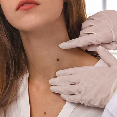 1749637813-Mole_Removal.jpg