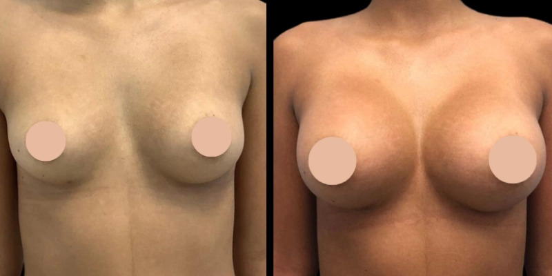 1749741038-H8-Breast-AugmentationH1-Breast-Augmentation.jpg