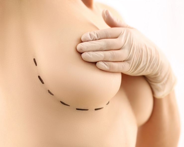 1749882176-How_Breast_Lift_Surgery_Works.jpg