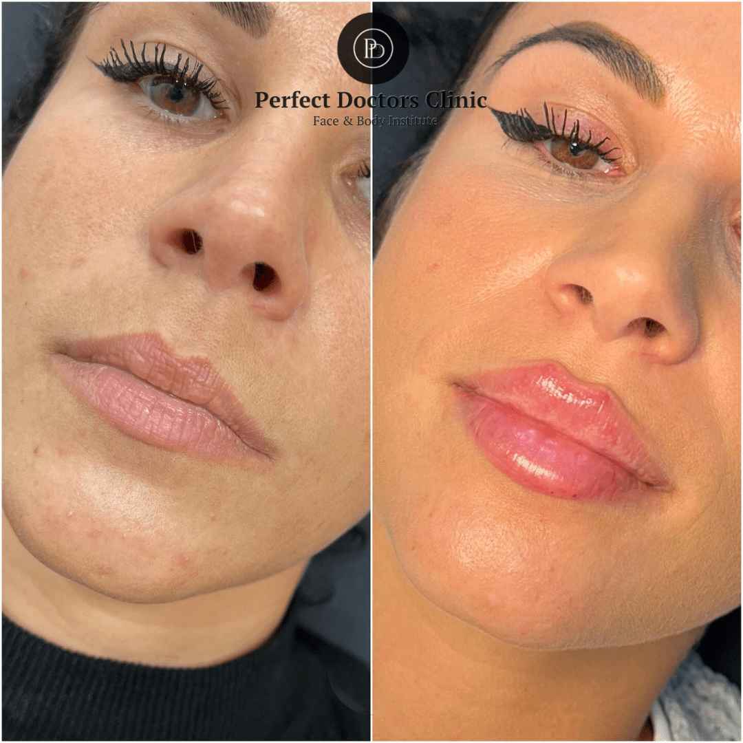 1752173421-Copy-of-lip-filler-3_11zon.jpg