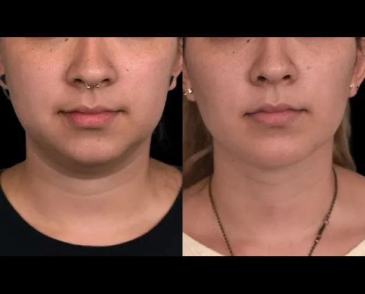 1752922654-Chin-liposuction-8_11zon.jpg
