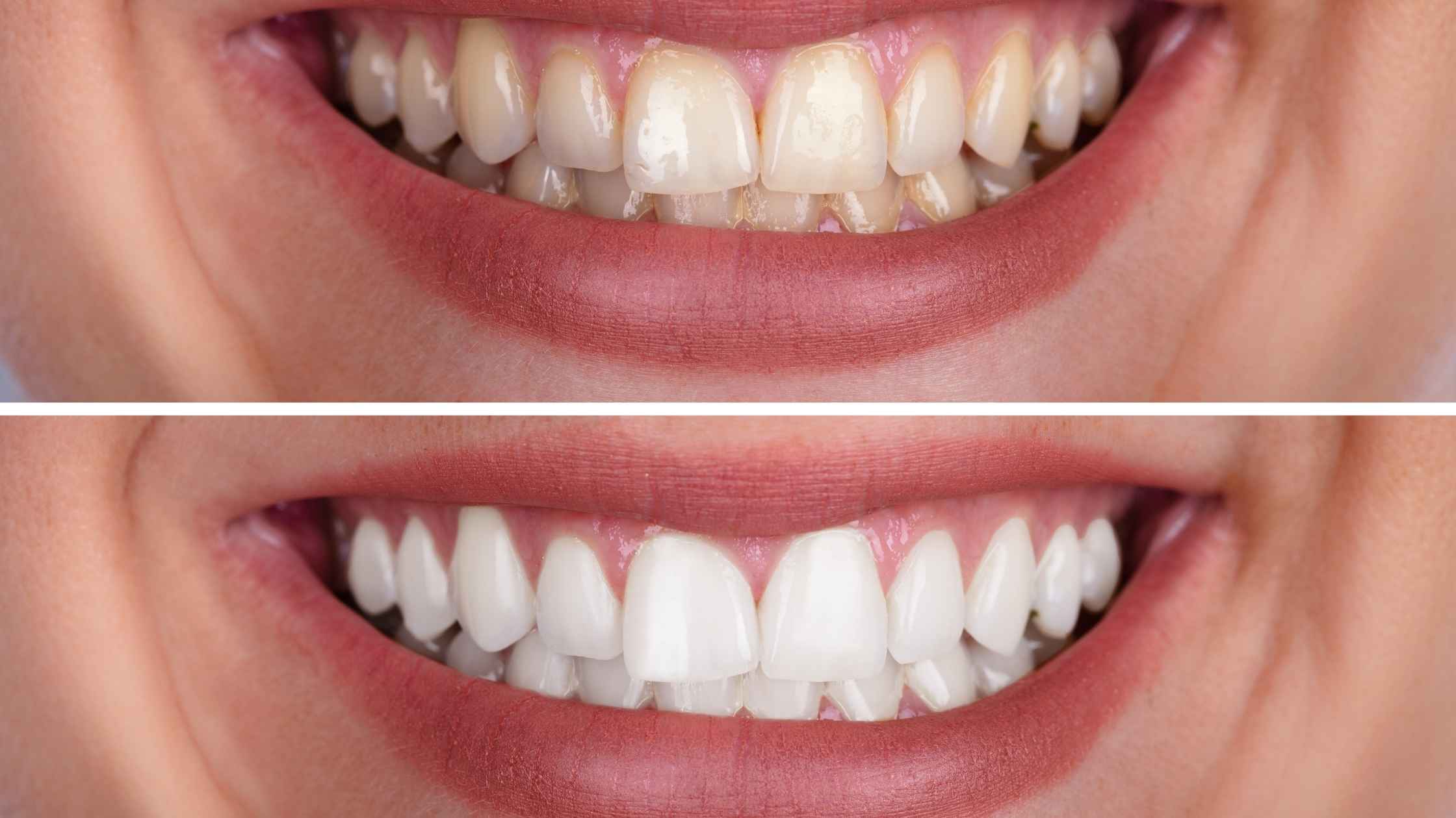 1753427000-teeth_whitening_West_Hollywood.jpg