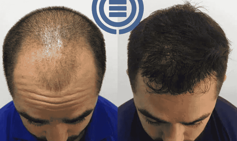 1753446443-before_and_after_hair_transplantion.png