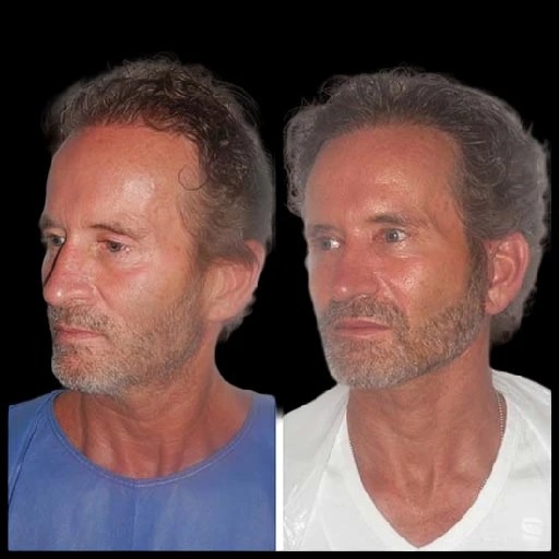 1753521152-H1-Facelift-Male.jpg