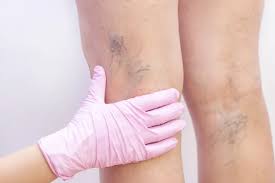 1753701020-home_remedies_for_varicose_veins.jpeg
