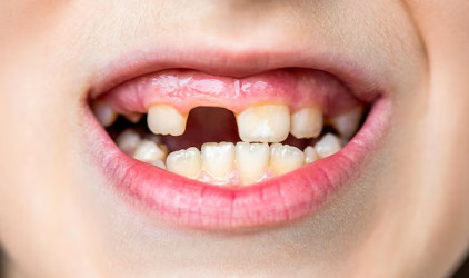 1754541718-missing_teeth_royal_oak_mi.jpg