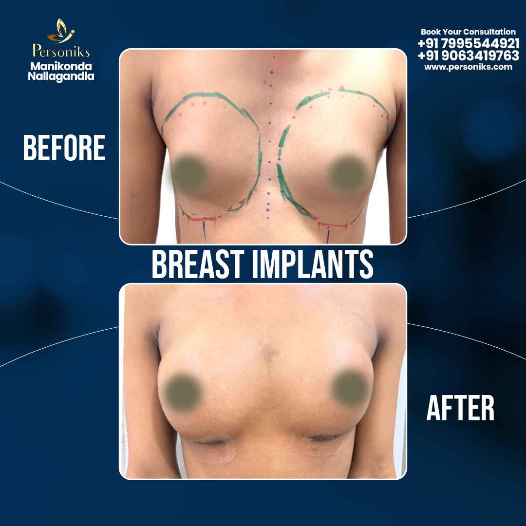 1762689521-Breast_Implants_07-11-2025_1_-_Copy_(1)_(1).jpg