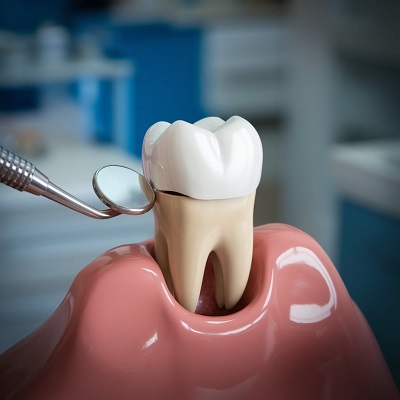 Dental_crown_in_islamabad.jpg