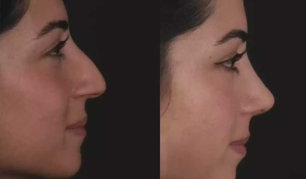H-Rhinoplasty-7_(2).jpg