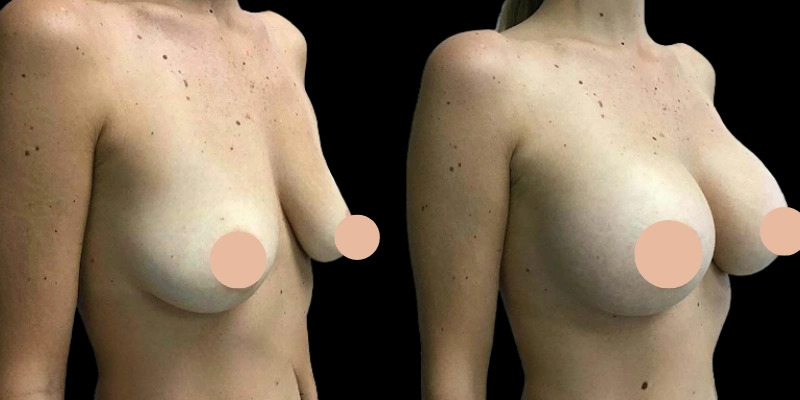 H11-Breast-Augmentation.jpg