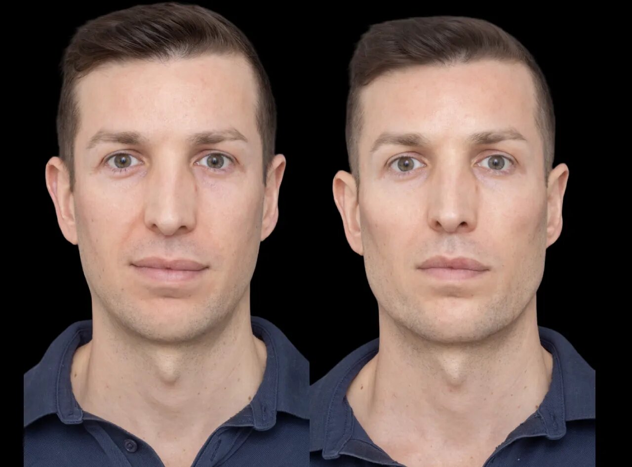 H2-Cheek-Fillers.jpg