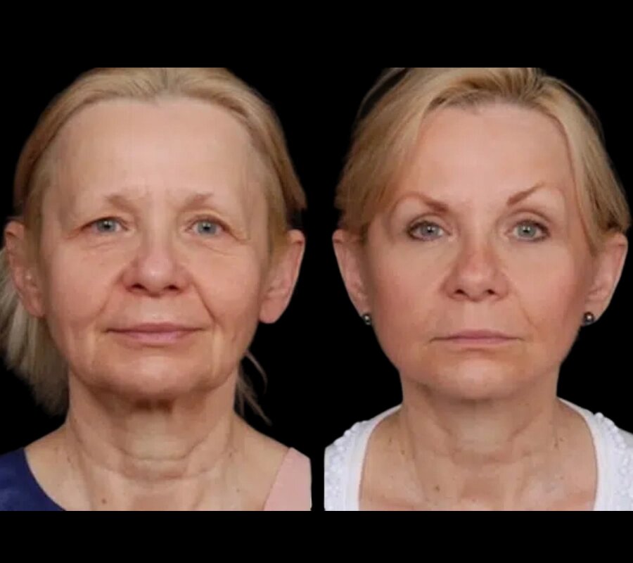H7-Under-eye-fillers.jpg